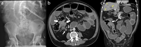 Obstructing Caecal Carcinoma