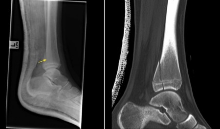 Salter-Harris IV Fracture – radiograph and CT
