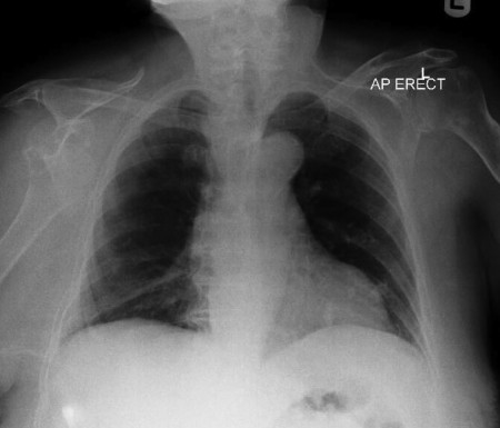 Glenohumeral dislocation – CXR