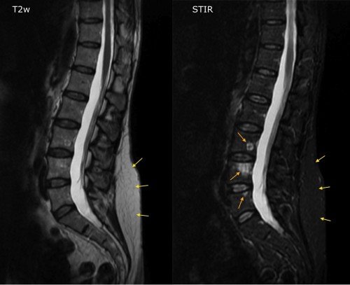 The image on the left is a T2-weighted image from a spinal MRI in a patient with breast cancer. On the right is an image from a STIR sequence - note how the vertebral marrow has become dark now that the signal from fat is suppressed (also compare the intensity of the subcutaneous fat on the two images, yellow arrows). We can now clearly see three high signal lesions in L3, L4 and L5 (orange arrows), which are almost invisible on the T2w sequence, and which turned out to be metastases. 