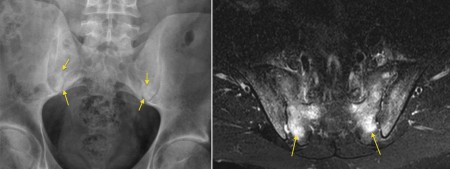 Sacroiliitis – MRI