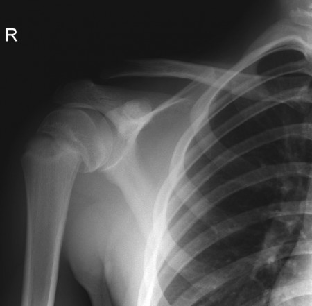 Salter Harris I fracture, proximal humerus