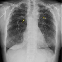 Pleural plaques from asbestos exposure \u2013 CT  Radiology at St. Vincent\u002639;s University Hospital