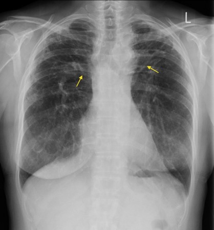 Sarcoidosis