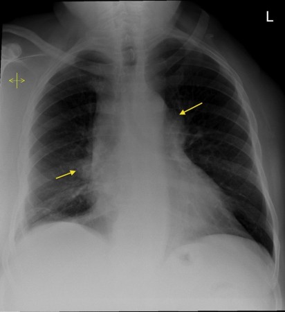 Sarcoidosis