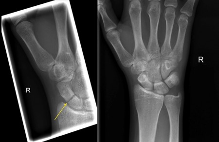 Scaphoid fracture