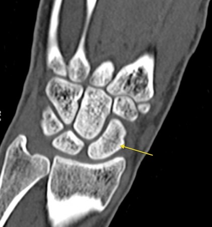 Scaphoid fracture