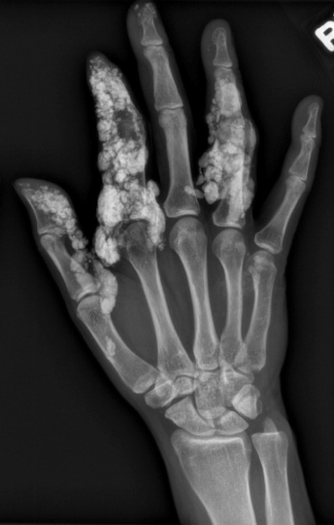 Scleroderma - Radiology at St. Vincent's University Hospital