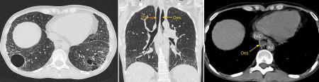 Scleroderma associated interstitial lung disease