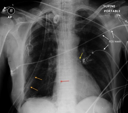 Selective intubation of left main bronchus