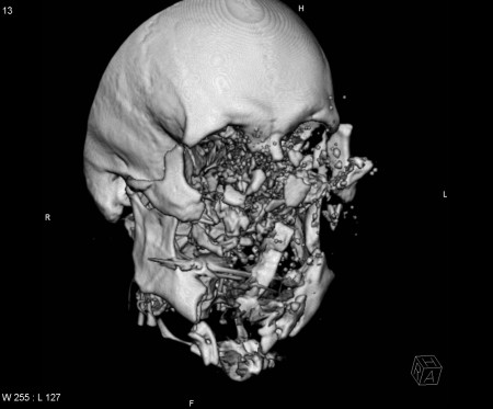 Shotgun injury – CT