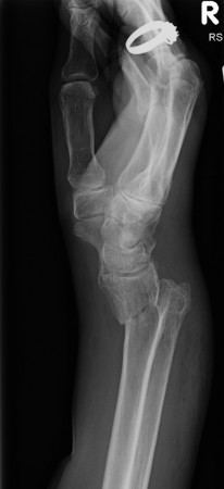 Smith’s fracture