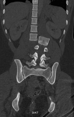 Lumbar spine dislocation