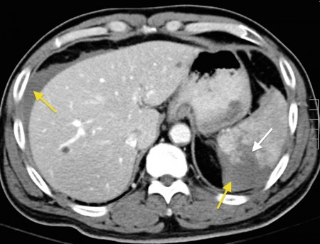 Splenic laceration