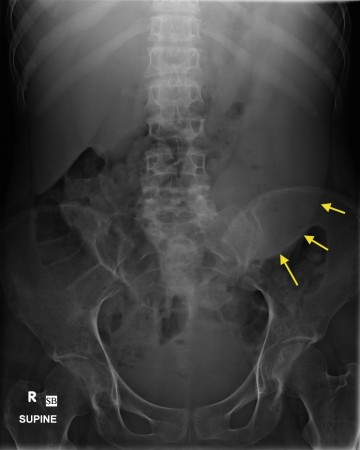 Splenomegaly – radiograph