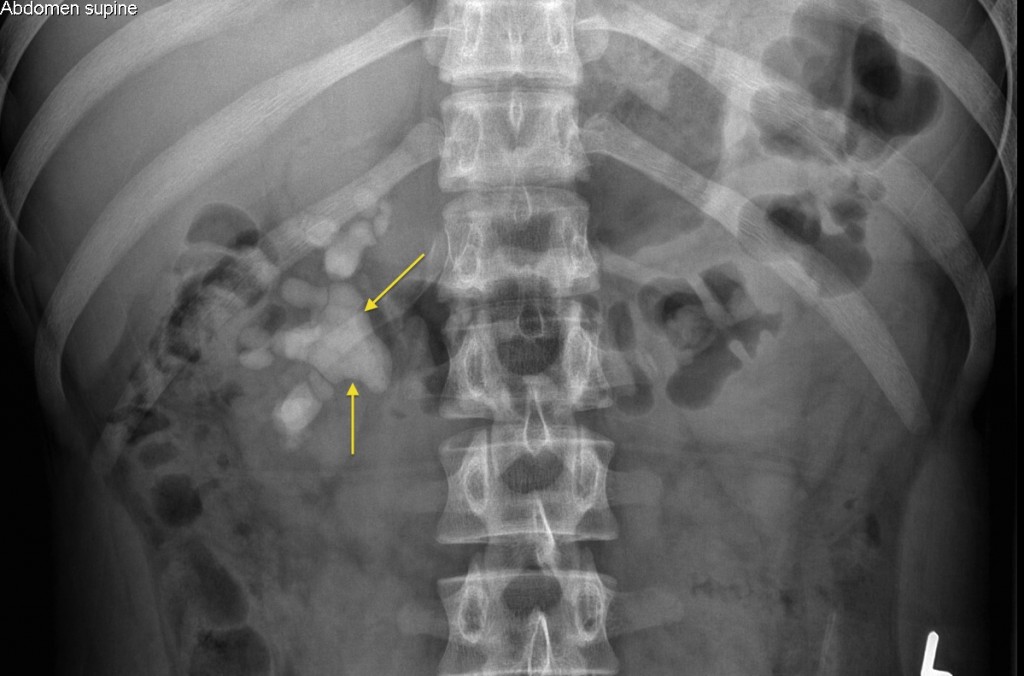 Staghorn calculus - Radiology at St. Vincent's University Hospital