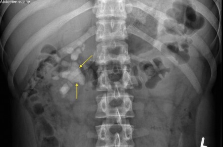 Staghorn calculus