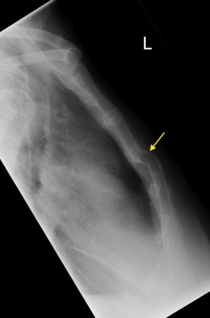 Sternal fracture