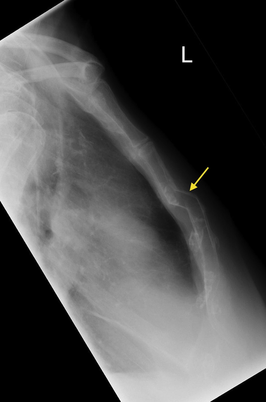 Sternal fracture Radiology at St. Vincent's University Hospital