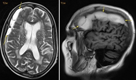 Subacute subdural haematoma – MRI