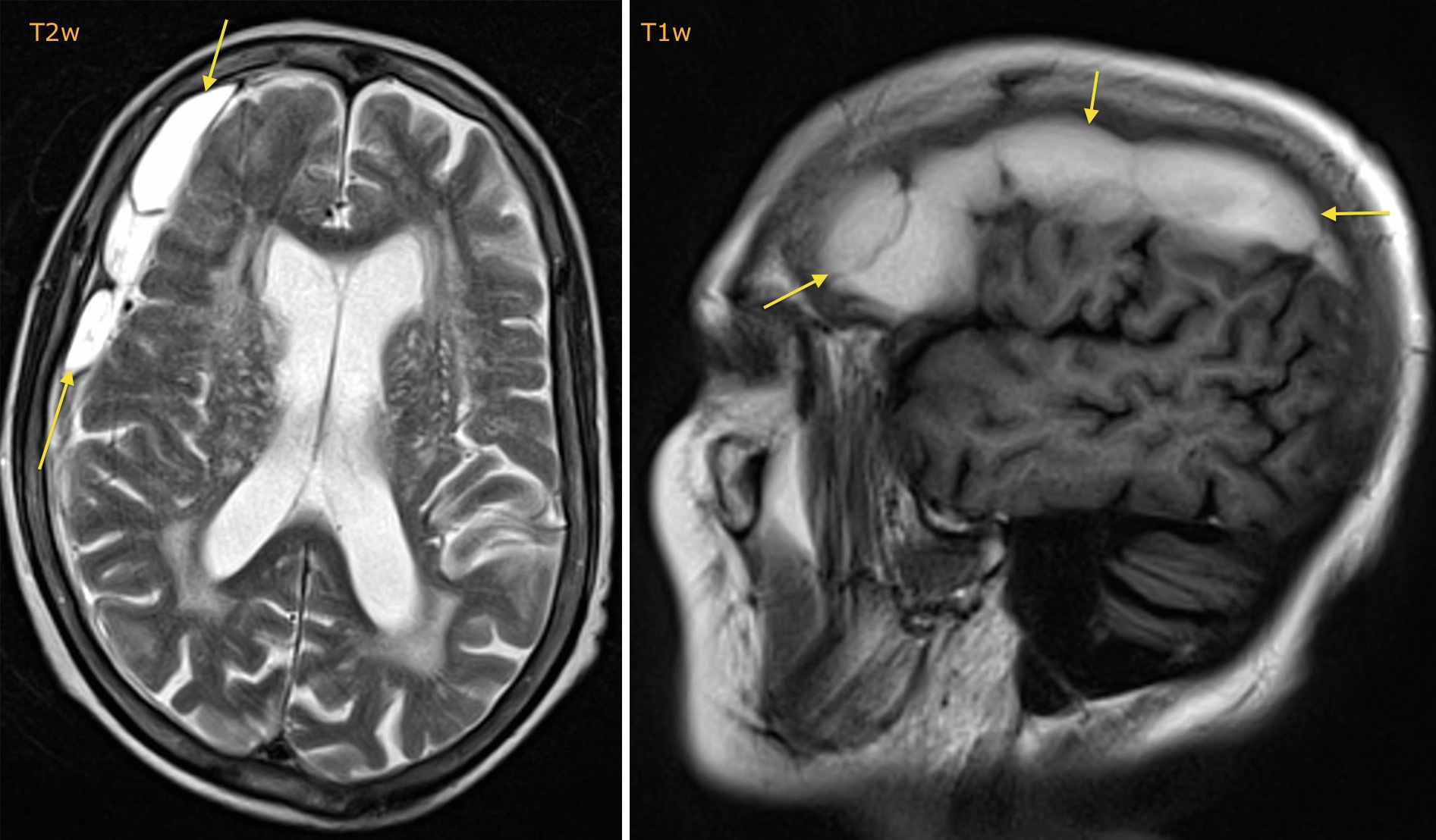 Dating Subdural Hematoma Mri Telegraph