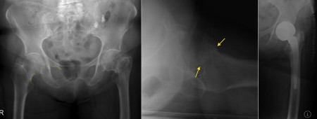 Femoral neck fracture
