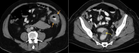 Synchronous Colorectal Carcinomas