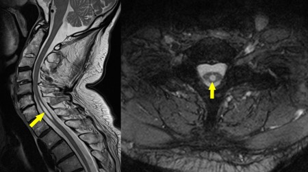 Syrinx – MRI