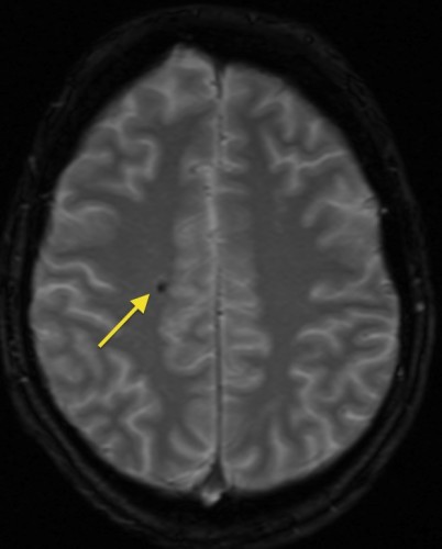 This is a T2* image, showing a small focus of low signal 'blooming' in the right frontal lobe, indicating a previous microhaemorrhage.