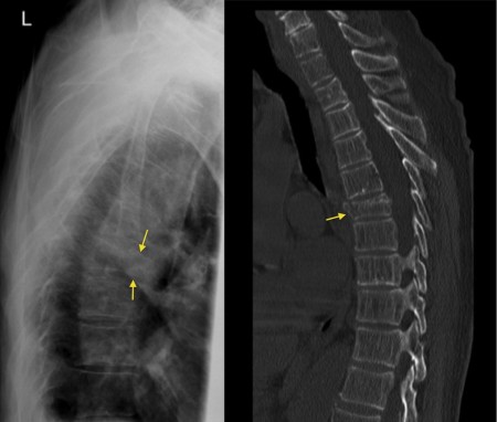 Thoracic spine fracture