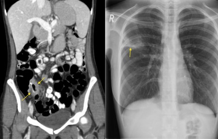 TB terminal ileitis