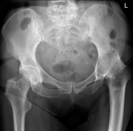 Previous septic arthritis