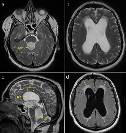 Obstructive hydrocephalus