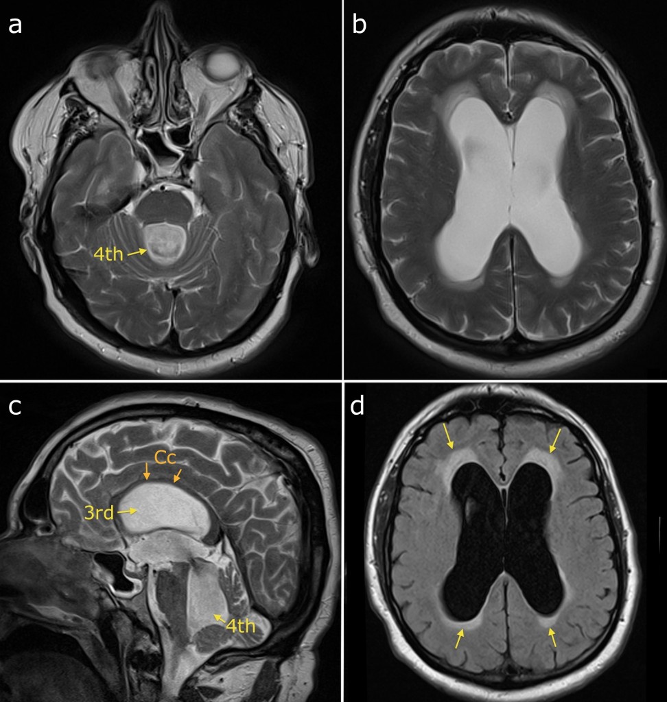 Obstructive hydrocephalus - Radiology at St. Vincent's University Hospital