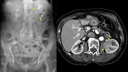 Transitional Cell Carcinoma