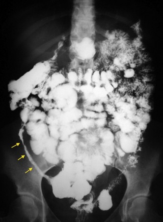 Crohn Disease – Barium Follow Through (2)