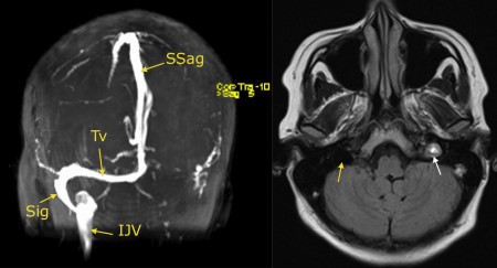 Venous sinus thrombosis