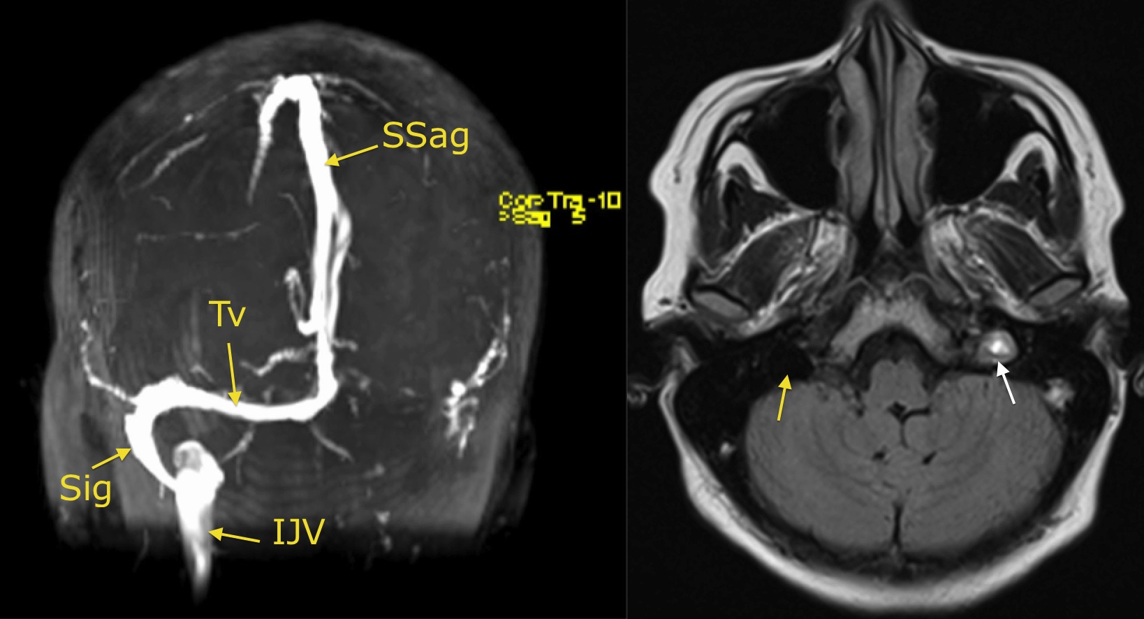 Venous sinus thrombosis - Radiology at St. Vincent's University Hospital