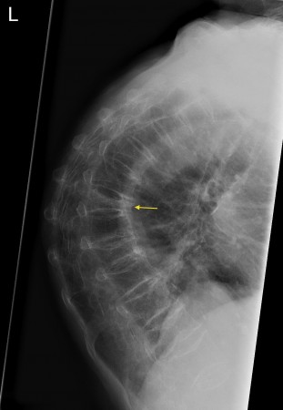 Osteoporotic fractures