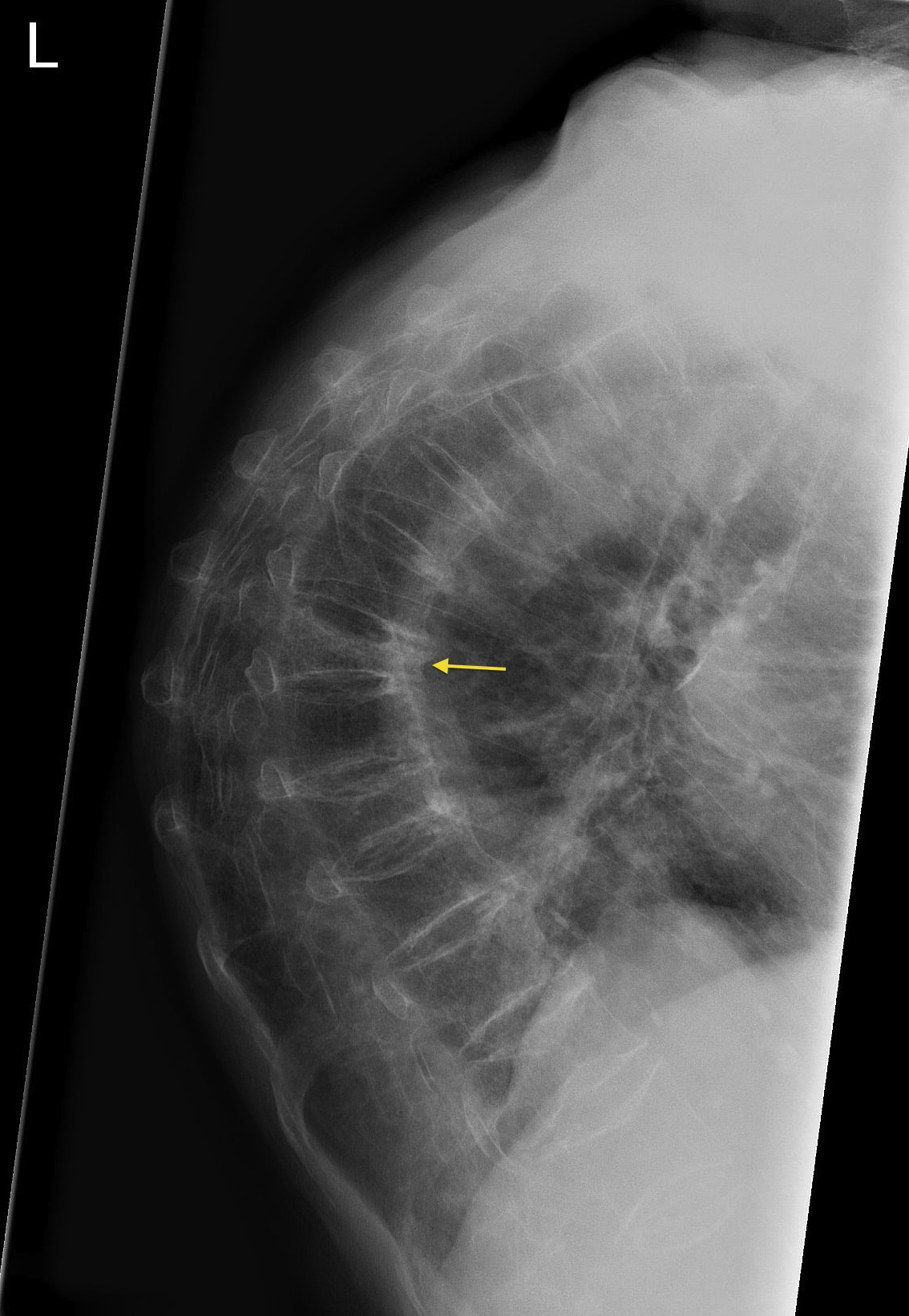 Osteoporotic fractures - Radiology at St. Vincent's University Hospital