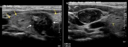 Thyroid carcinoma