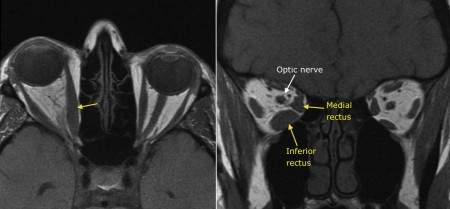 Thyroid eye disease