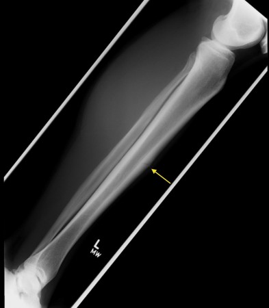Stress fracture of tibia