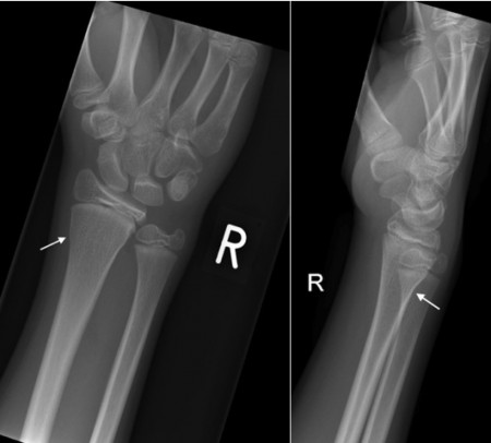 Buckle fracture