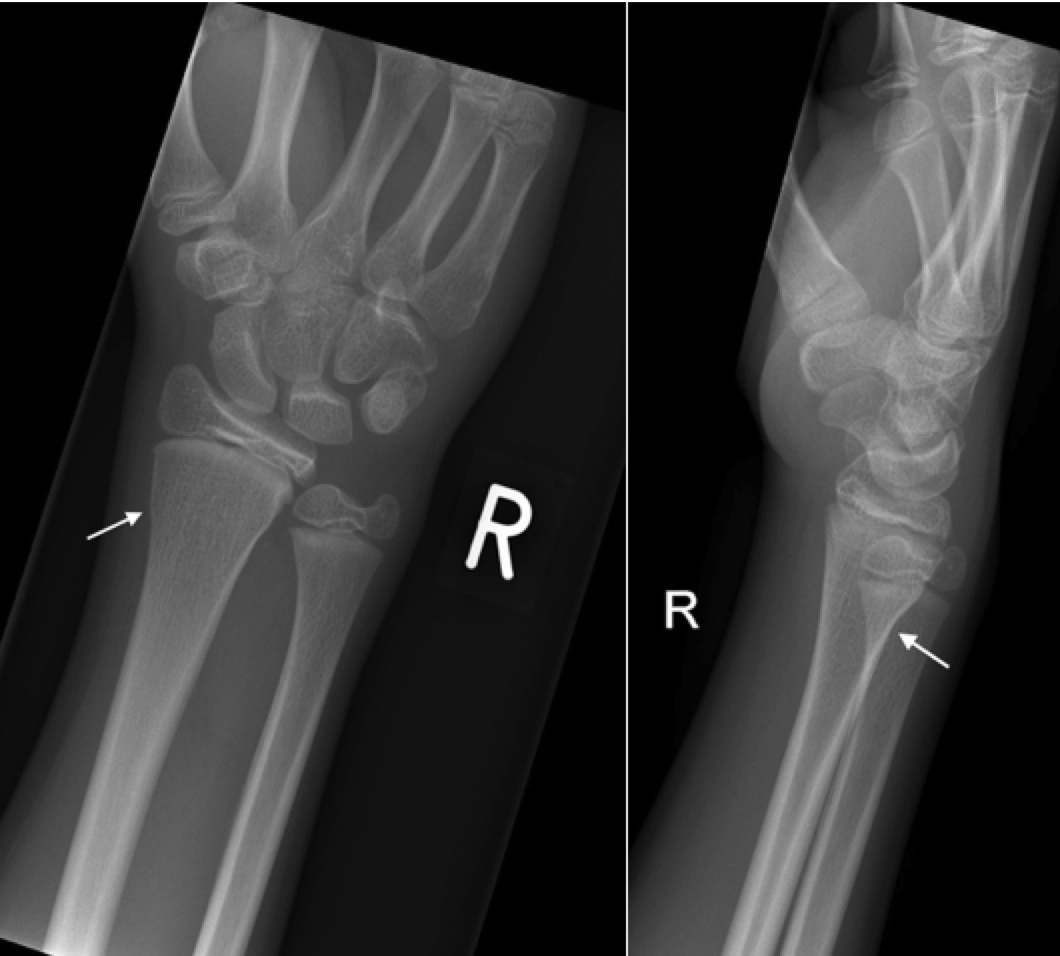 Colles fracture, Radiology Case