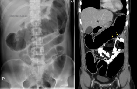 Toxic megacolon – PFA/CT