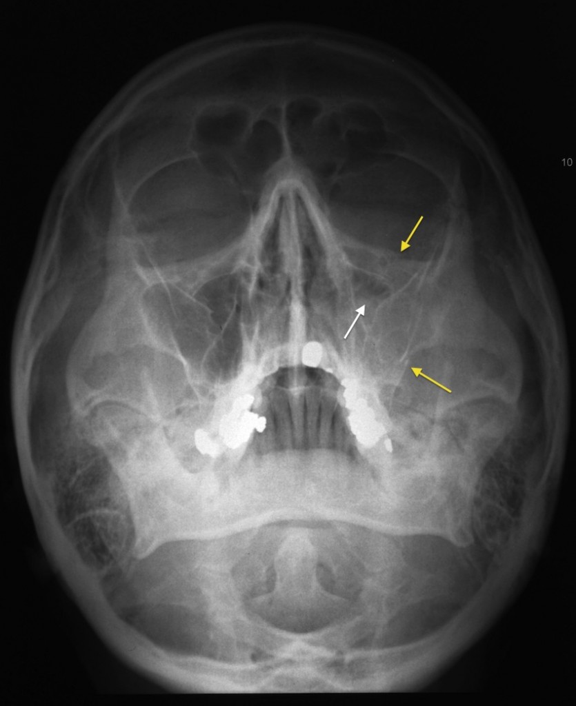 Tripod fracture - Radiology at St. Vincent's University Hospital