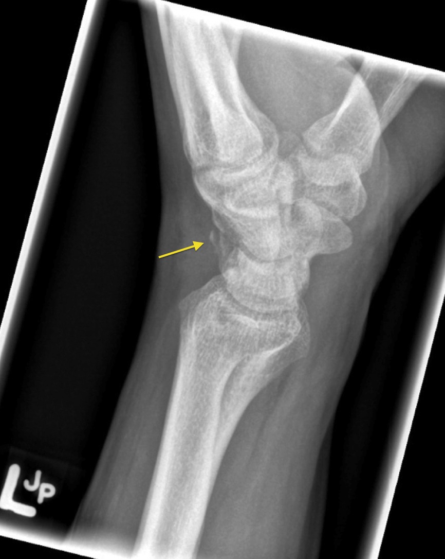 Triquetral fracture - Radiology at St. Vincent's University Hospital