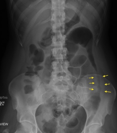 Colitis – PFA