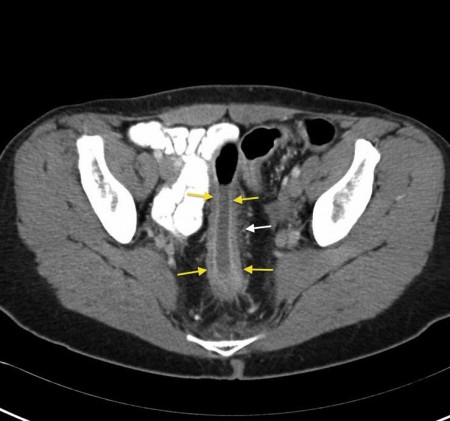 Proctitis – CT